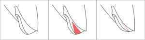 Labioplastika