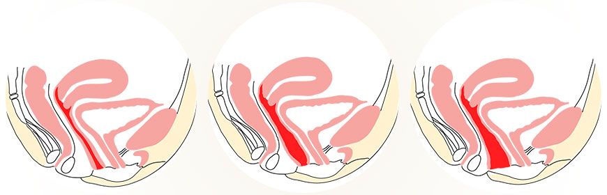 vaginoplastika - zúžení pochvy